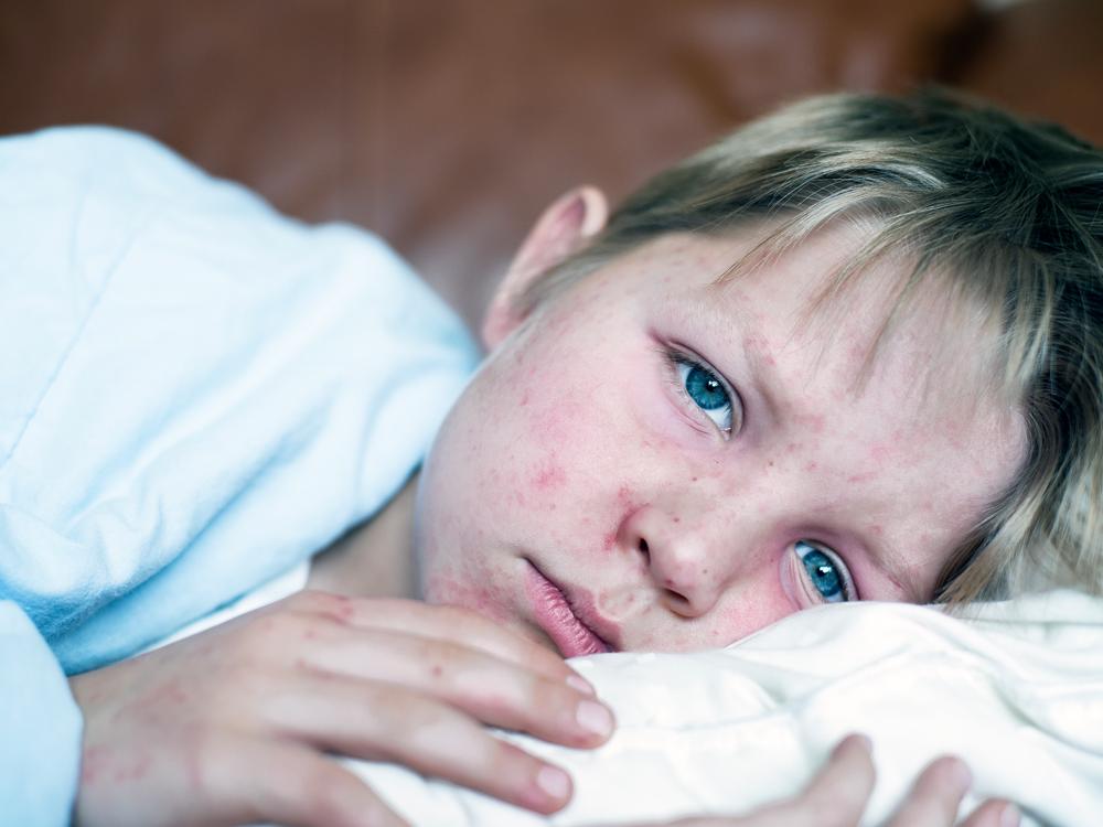 A close-up of a young child with their head on a pillow. Eyes are open, looking toward the camera. The face has a rash that appears to be measles.