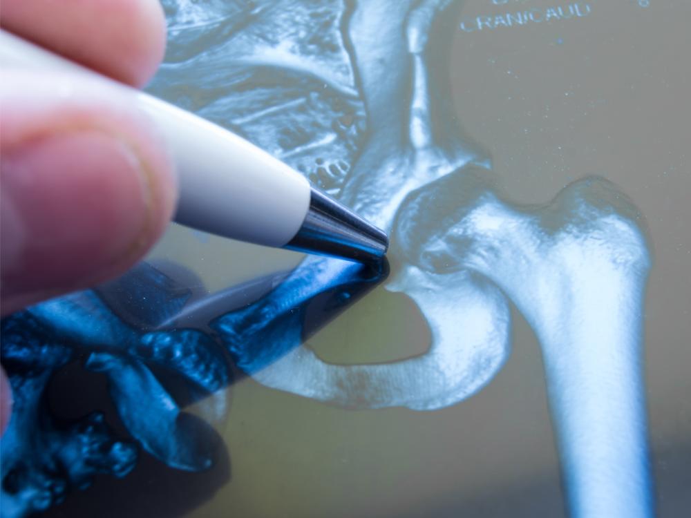 A close-up of a portion of an X-ray that depicts a pelvic joint. A hand holds a pen closeby, with the pen tip pointing toward the joint.