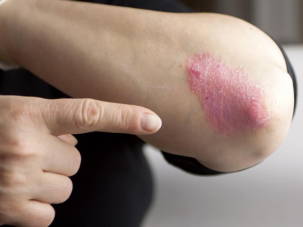 A person with Psoriasis holds up their right elbow, which has a rash, pointing to it with their left hand.