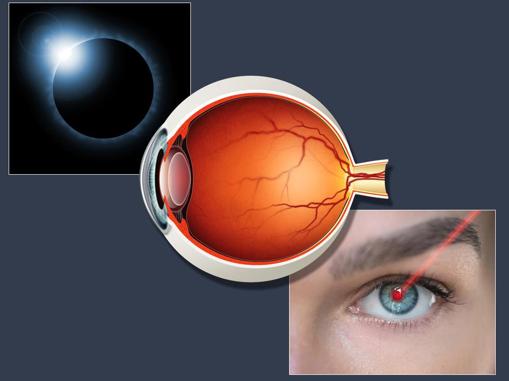 Three overlapping images, one depicting a solar eclipse, one side angle of a retina and the third depicting a red laser shining into an eye.