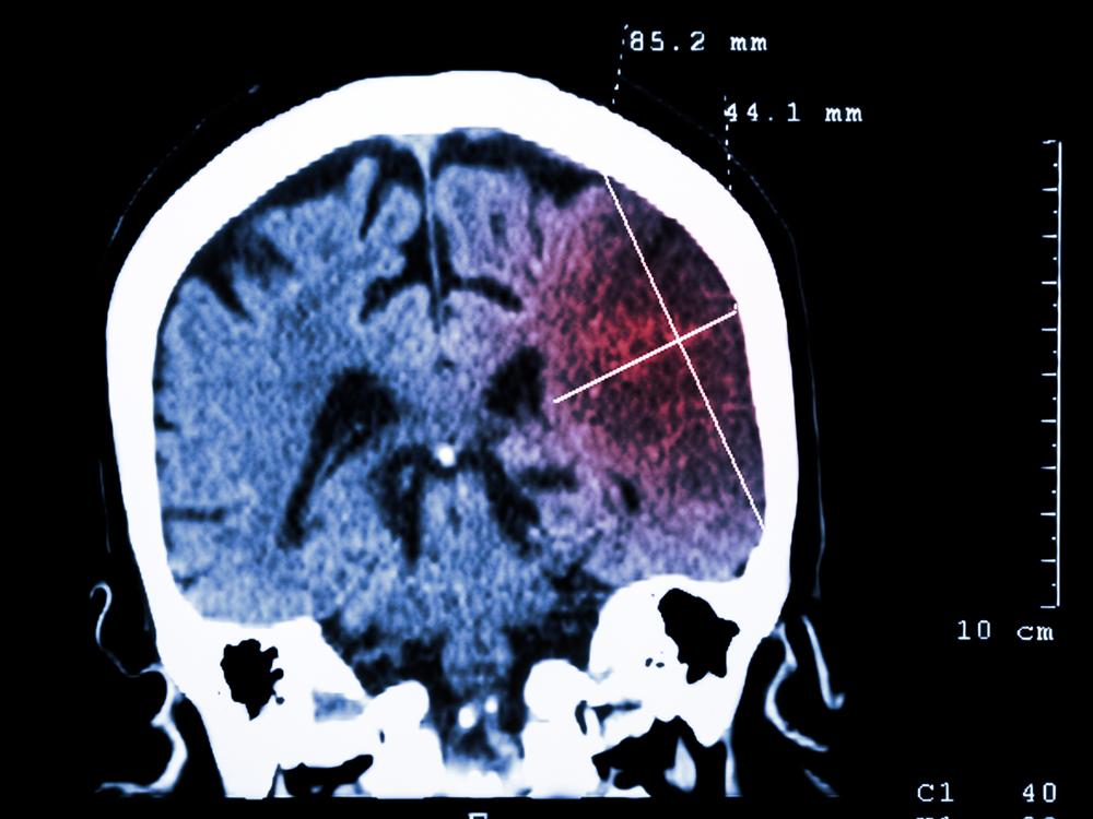 A digital scan depicts the brain in blue, with an area on the right side a shade of red, depicting the site of a stroke.