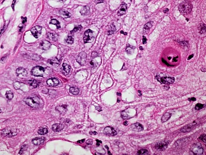 well-differentiated squamous cell carcinoma