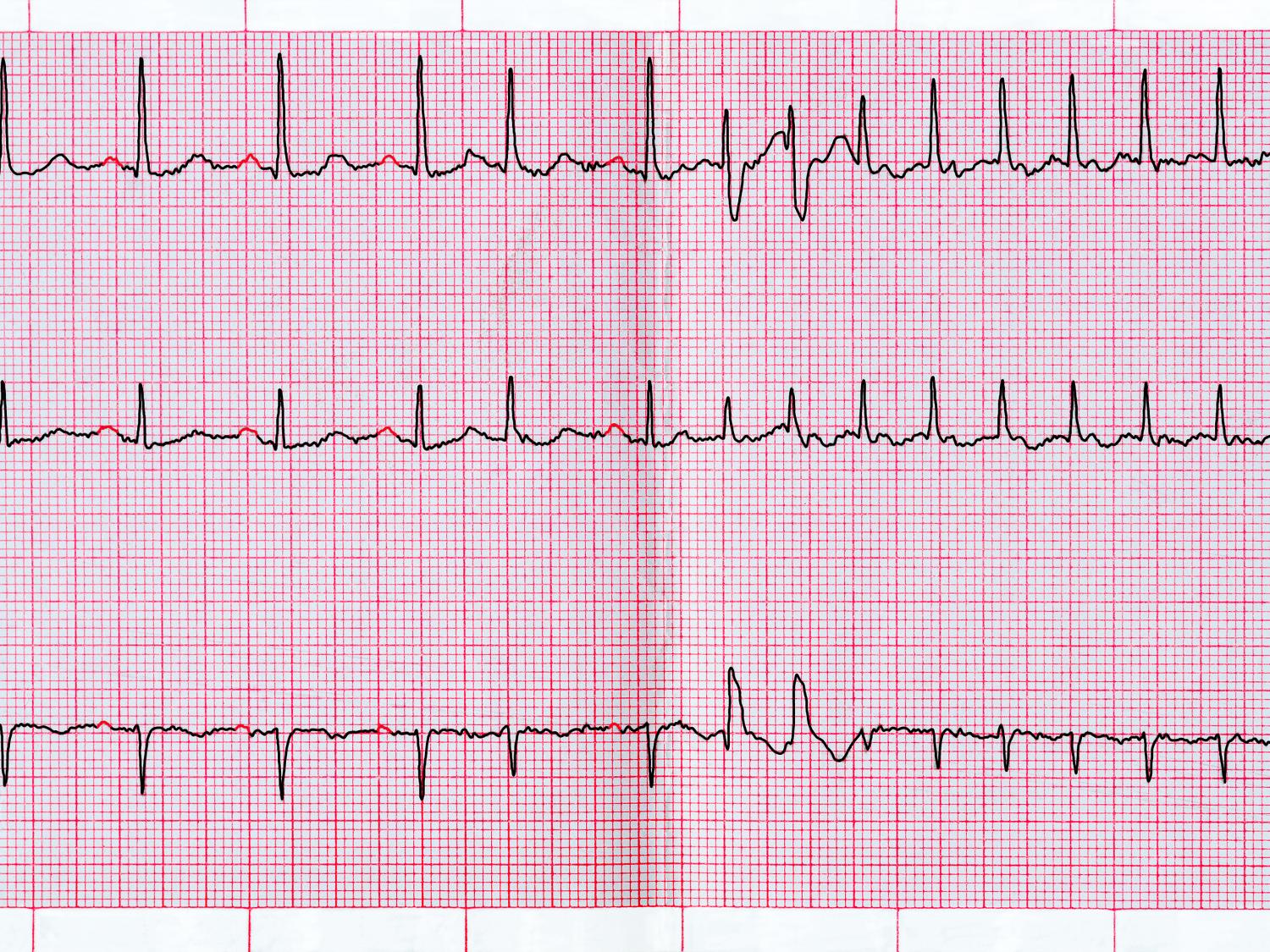 a fib on EKG