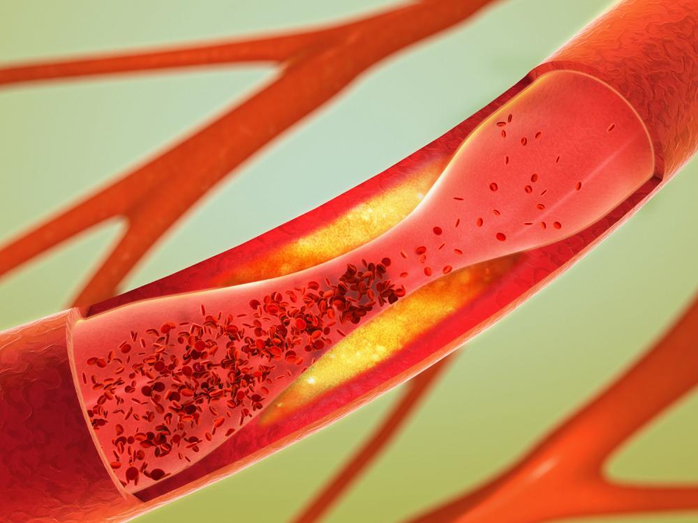 A close-up depiction of arteries, shown in red against a light green background. The largest artery in view has a partial blockage.