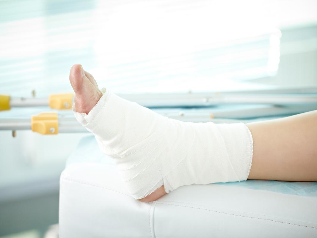 Photo shows a broken foot in a cast 