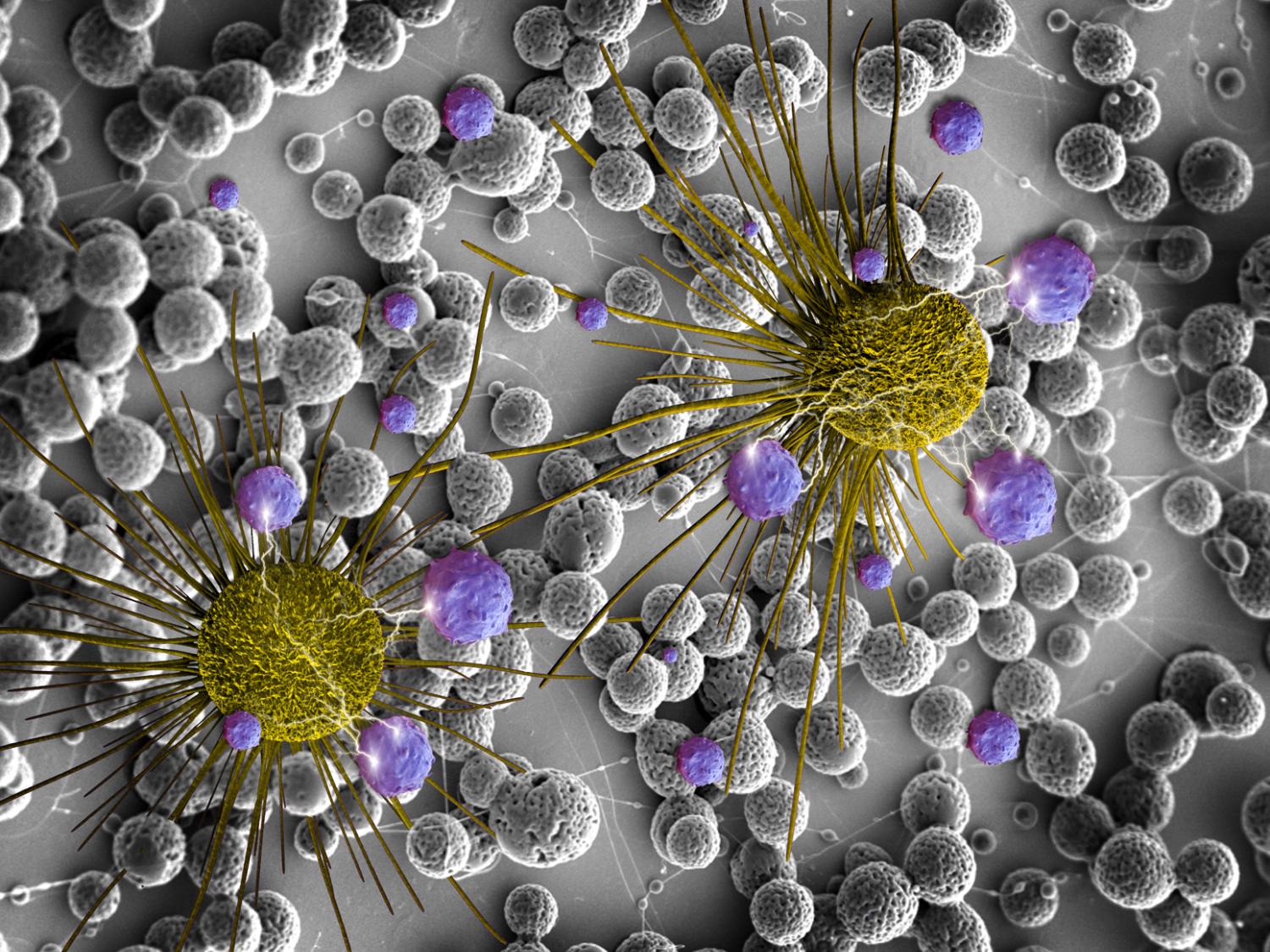 brain cancer cells and released BCNU