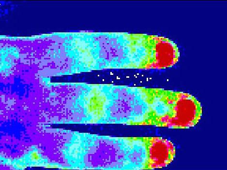 Kenney-fingertips laser speckle