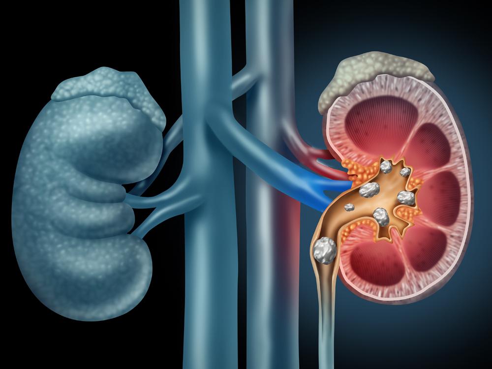 A color illustration of two kidneys, side by side. The one on the right is depicted as a cross-section, and we see several stones inside of it.