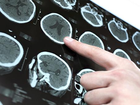 A finger points to a scan of a brain.