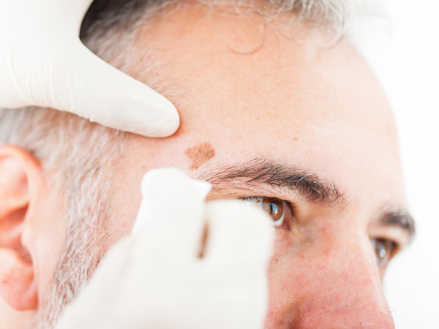 Close up shot of a man having a mole on his forehead examined