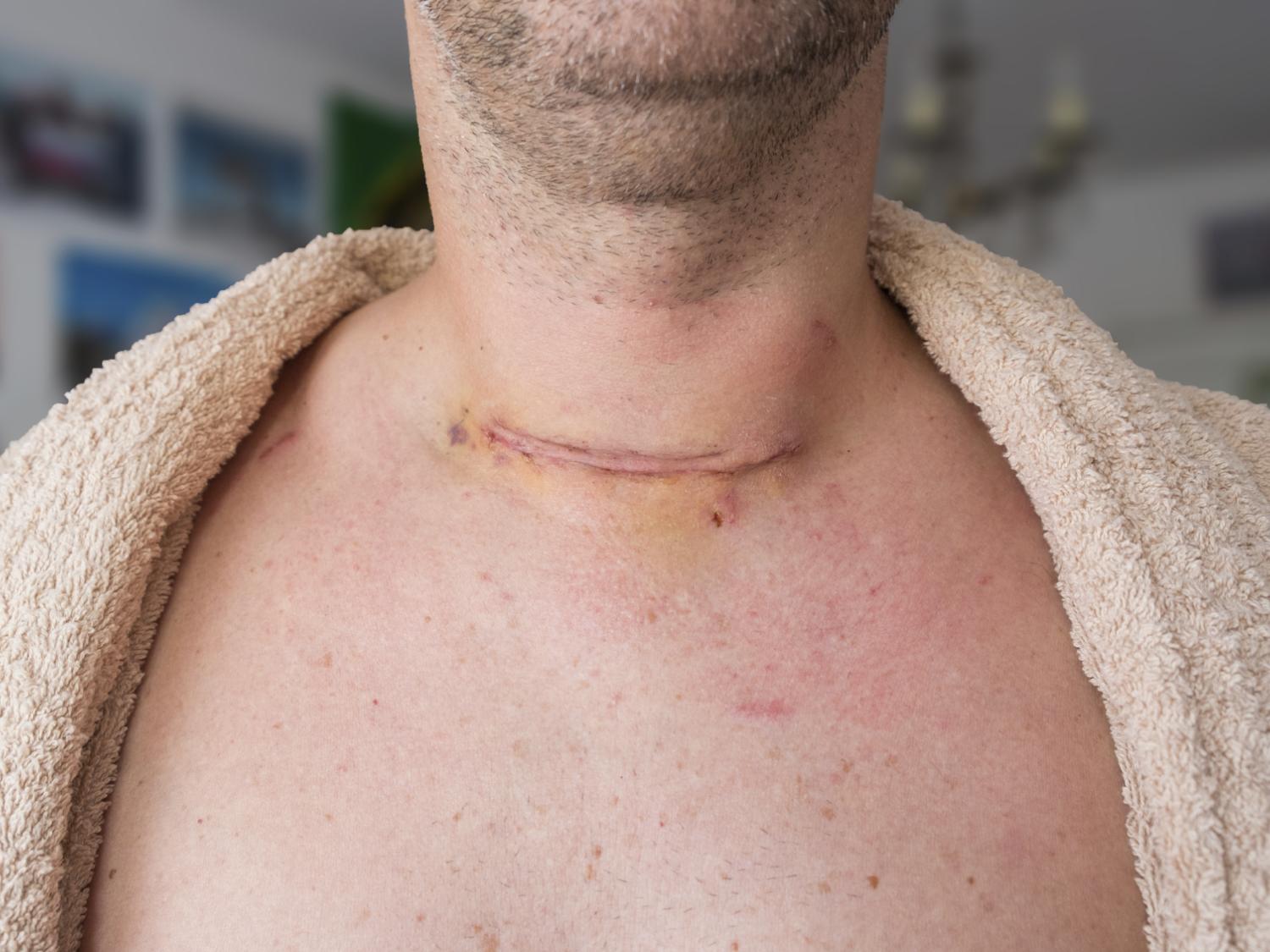 thyroid surgery scar on man's throat