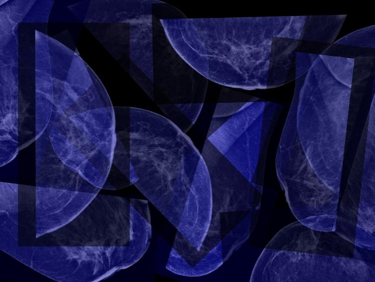mammograms abstract
