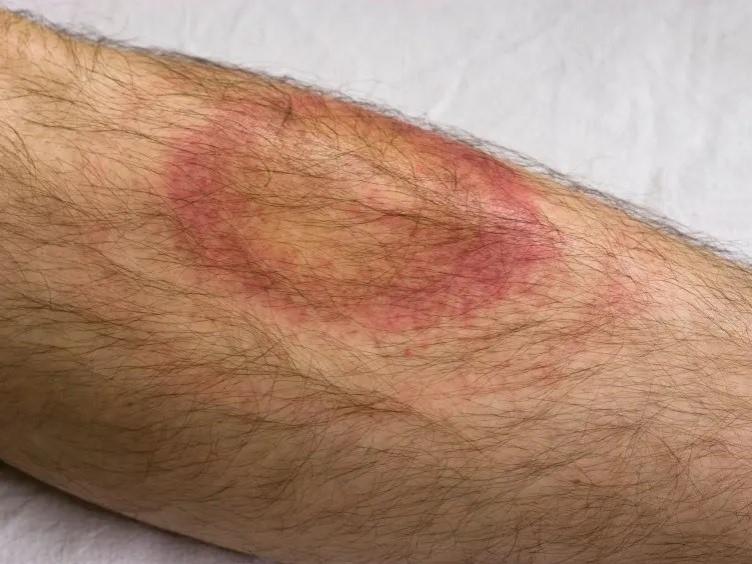 tick skin lesion