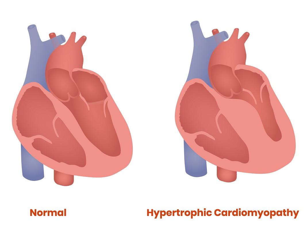 Normal heart and hypertrophic heart are shown in an illustration.