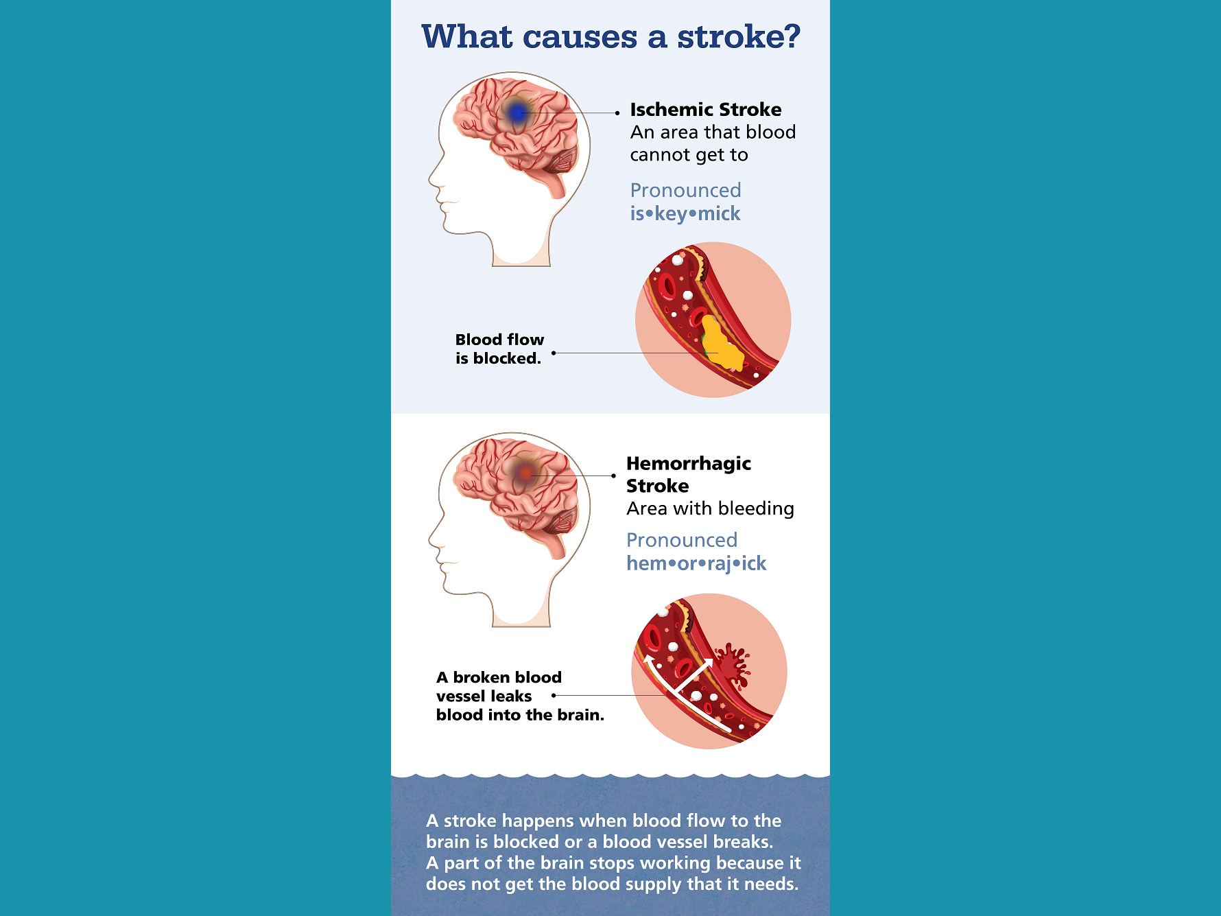 A graphic depicting two types of stroke. This text also is included in the text of the story.