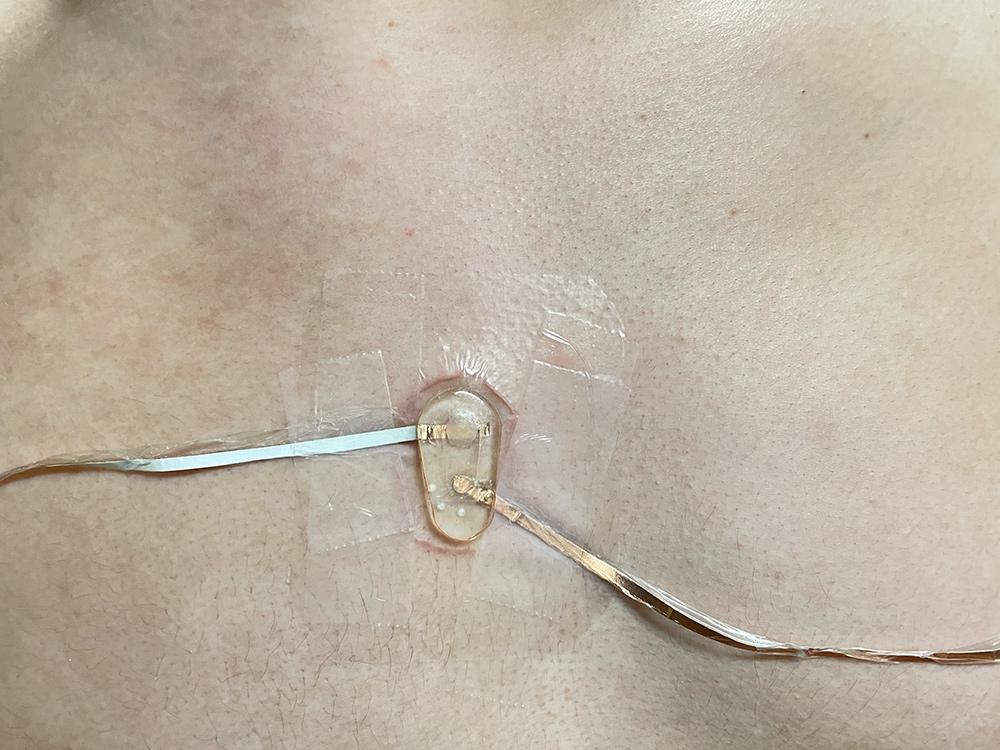 The sensor attached to a subjects chest. You can see the electronics that power it's OCV sensor, including the hydrogel.