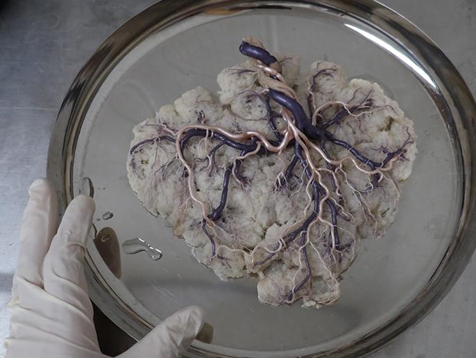 a human placenta injected with colored resin and leaves a sponge-like substance with different colored veins resembling a tree with no leaves