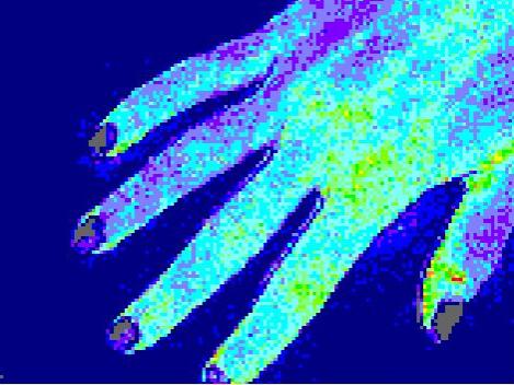 Kenney-laser speckle image of hand with  normal blood flow