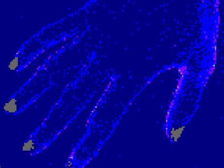 Kenney-laser speckle image of the back of a hand with blocked blood flow.