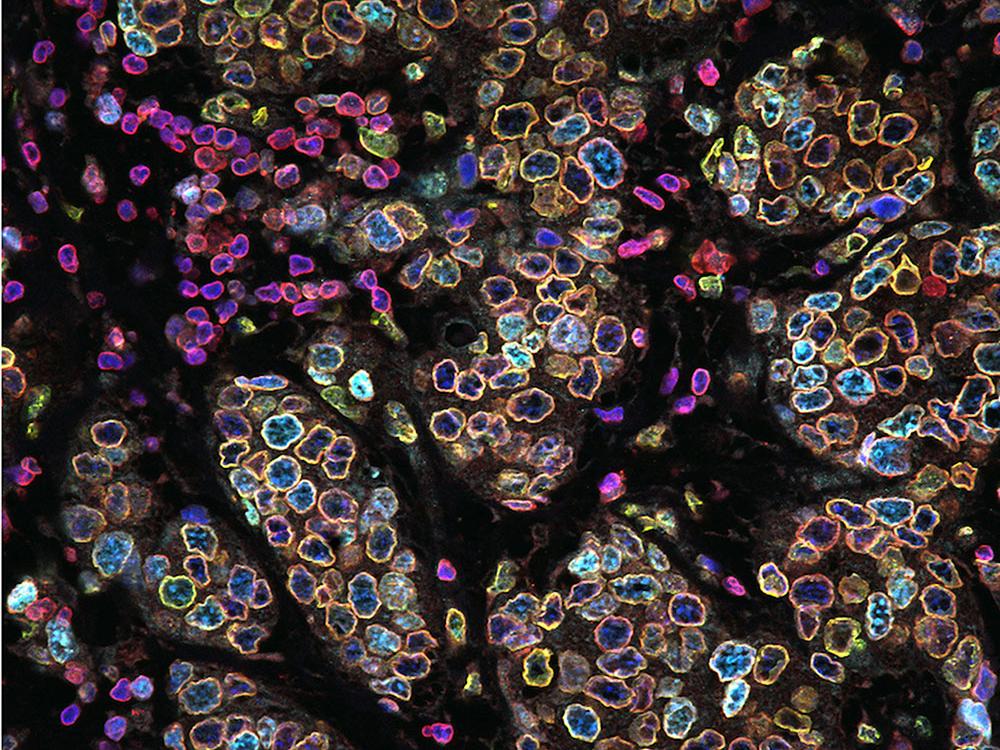 breast cancer cells