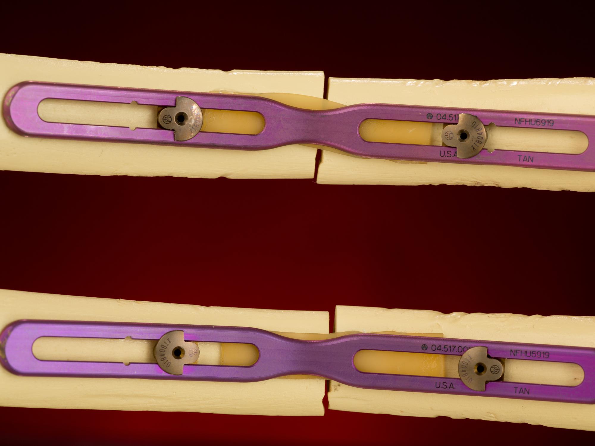 interior view of rib fixation device