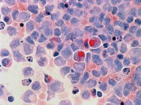 Dietary selenium may help fight acute myeloid leukemia, researchers ...